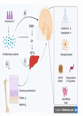 Association of neurodegeneration, cognitive impairment, and short stature in Down syndrome; Could proinflammatory cytokines be t